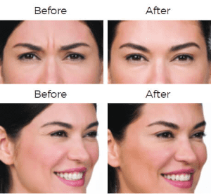 Botox Cosmetic Before & After Image