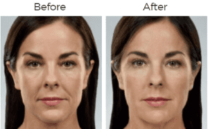 Juvederm  Before & After Image