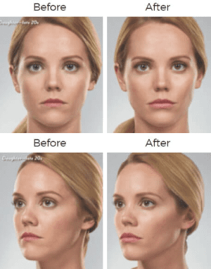 Juvederm  Before & After Image