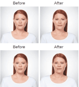 Kybella  Before & After Image