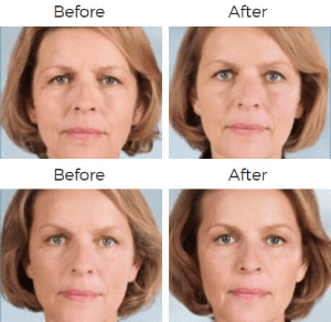 Sculptra Aesthetic Before & After Image