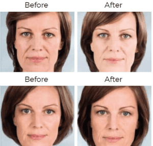 Sculptra Aesthetic Before & After Image