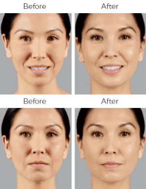 Voluma Before & After Image
