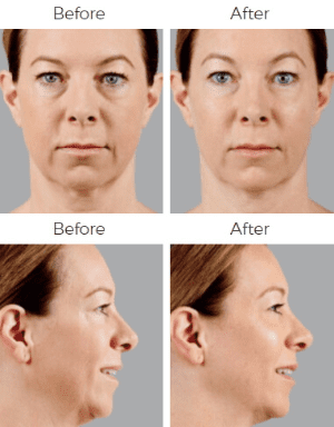 Voluma Before & After Image
