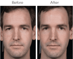 Clear & Brilliant Before & After Image