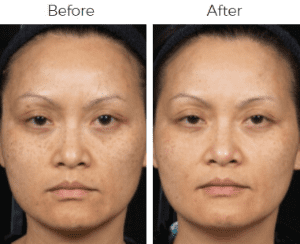 Clear & Brilliant Before & After Image