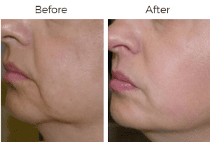 Thermage Before & After Image