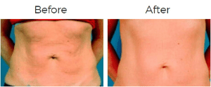 Thermage Before & After Image