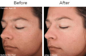 Rejuvenize Peel Before & After Image