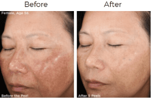 Rejuvenize Peel Before & After Image