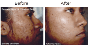Vitalize Peel Before & After Image
