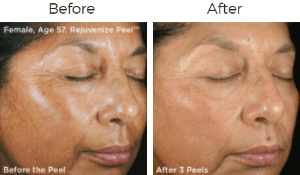 Vitalize Peel Before & After Image