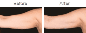 CoolSculpting Before & After Image