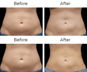 CoolSculpting Before & After Image