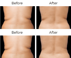 CoolSculpting Before & After Image