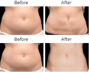 CoolSculpting Before & After Image