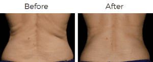 CoolSculpting Before & After Image