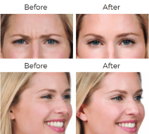 Botox Cosmetic Before & After Image