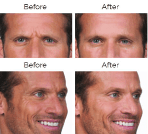 Botox Cosmetic Before & After Image