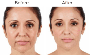 Juvederm  Before & After Image