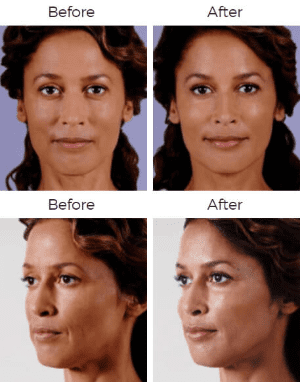 Juvederm  Before & After Image