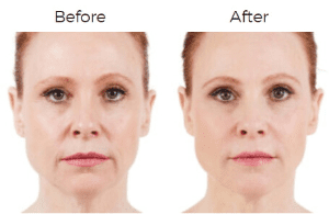 Juvederm  Before & After Image