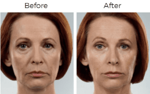 Juvederm  Before & After Image