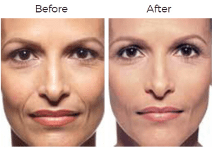 Juvederm  Before & After Image