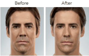 Juvederm  Before & After Image