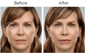 Juvederm  Before & After Image