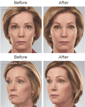 Juvederm  Before & After Image