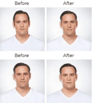 Kybella  Before & After Image