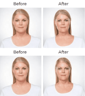 Kybella  Before & After Image