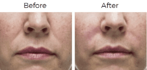 Radiesse Before & After Image