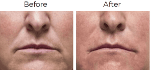 Radiesse Before & After Image