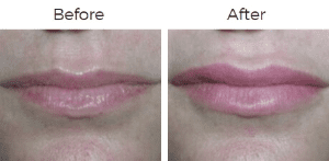 Restylane Before & After Image