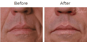 Restylane Before & After Image