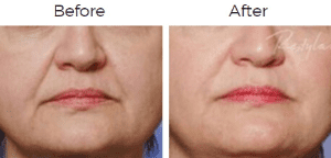 Restylane Before & After Image