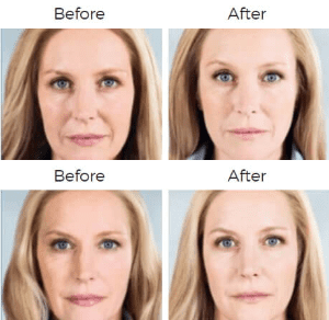 Sculptra Aesthetic Before & After Image