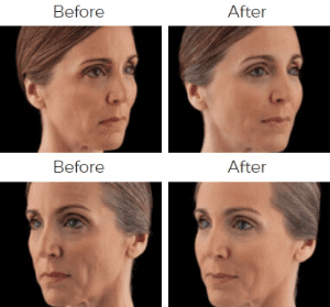 Voluma Before & After Image