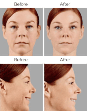 Voluma Before & After Image