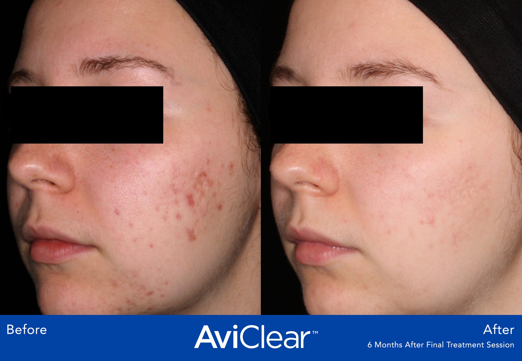 Aviclear Before & After Image