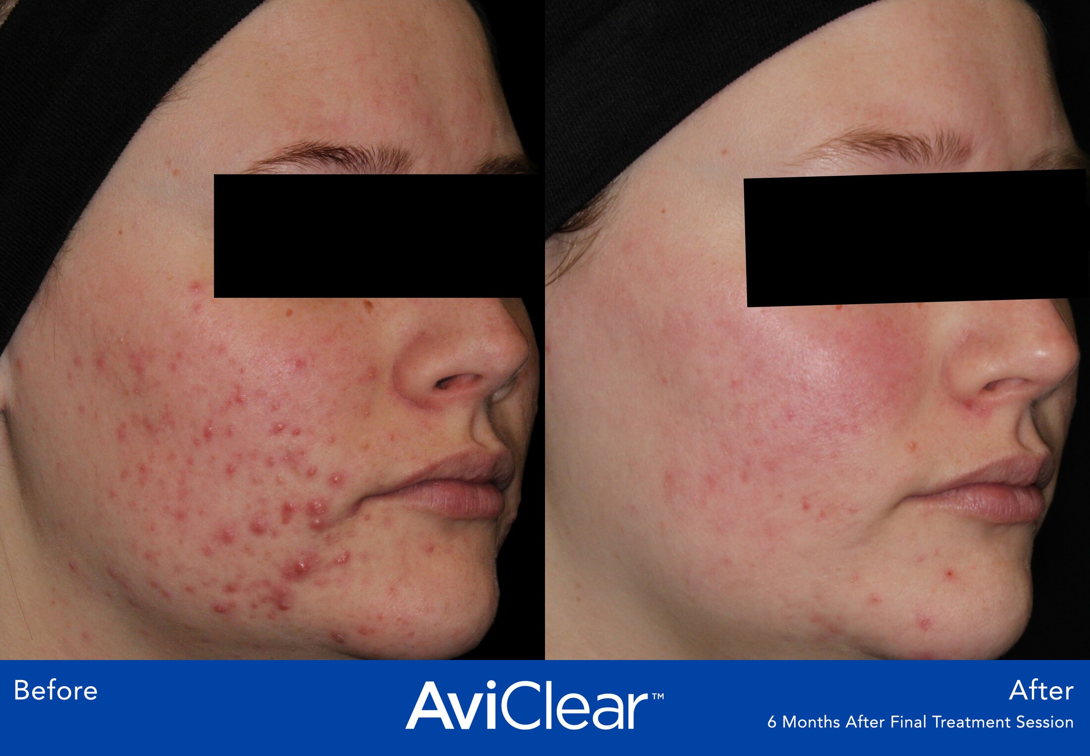 Aviclear Before & After Image