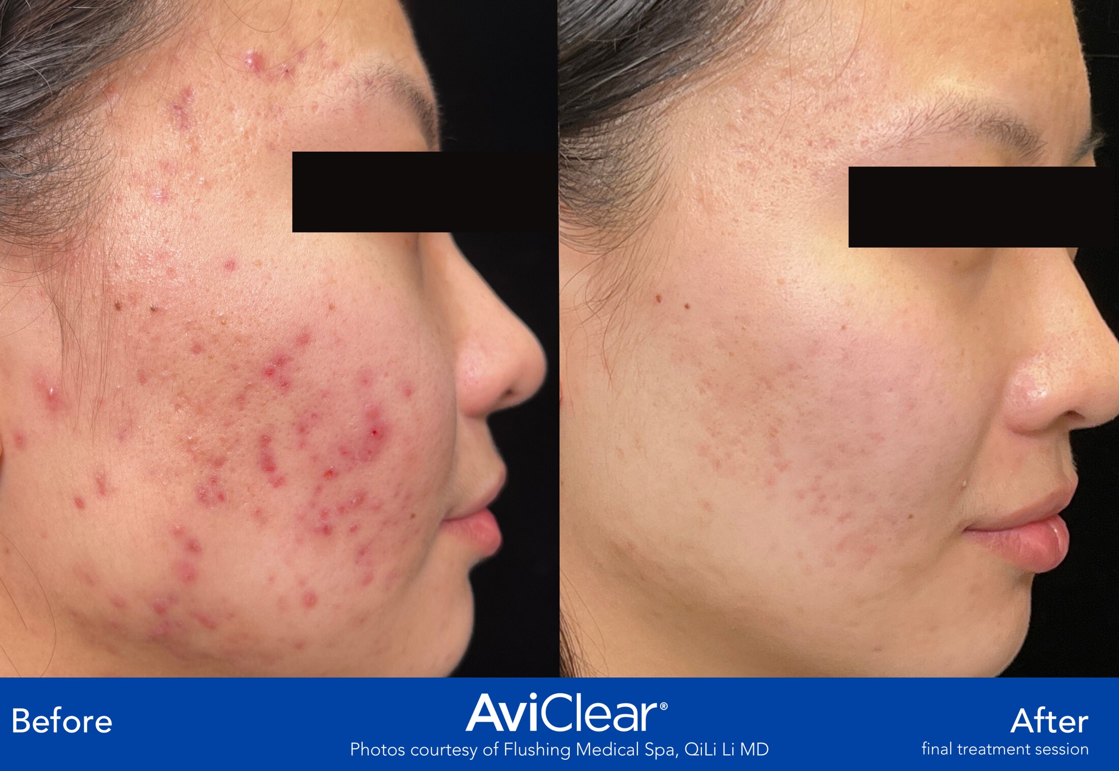 Aviclear Before & After Image