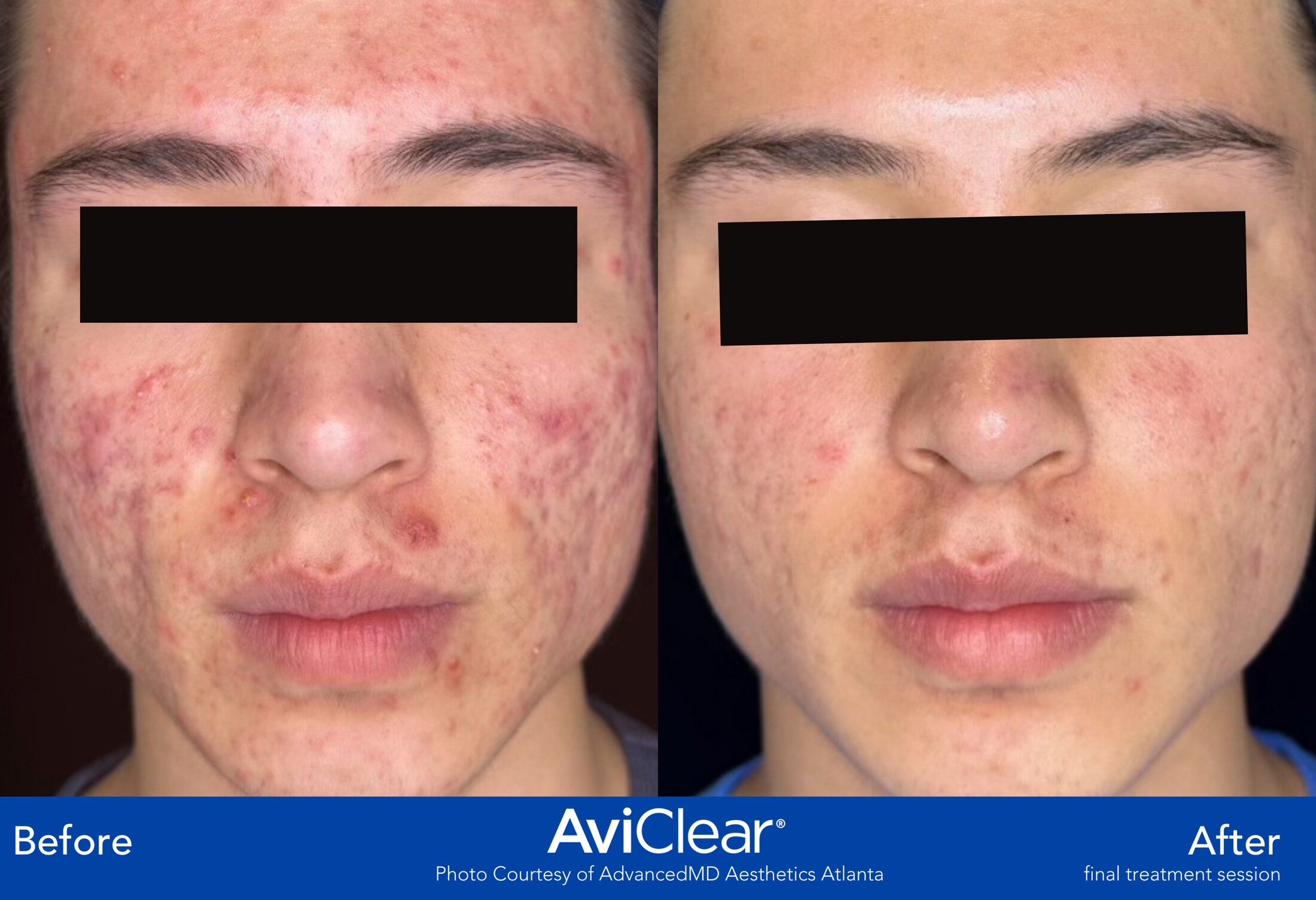 Aviclear Before & After Image