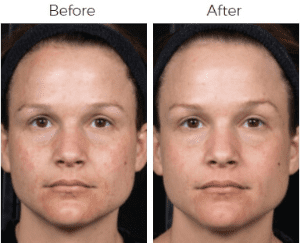 Clear & Brilliant Before & After Image