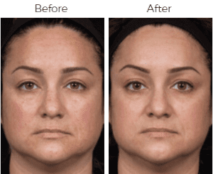 Clear & Brilliant Before & After Image