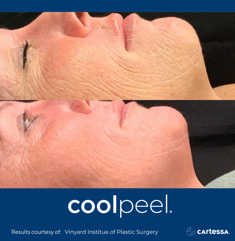 CoolPeel Before & After Image