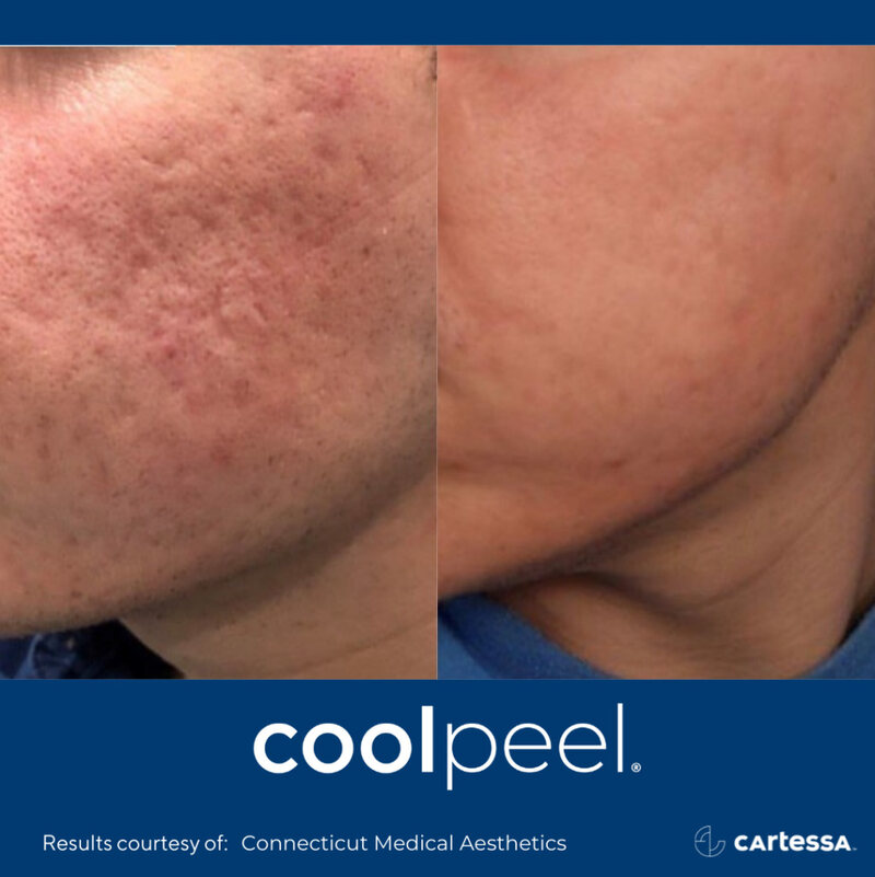 CoolPeel Before & After Image
