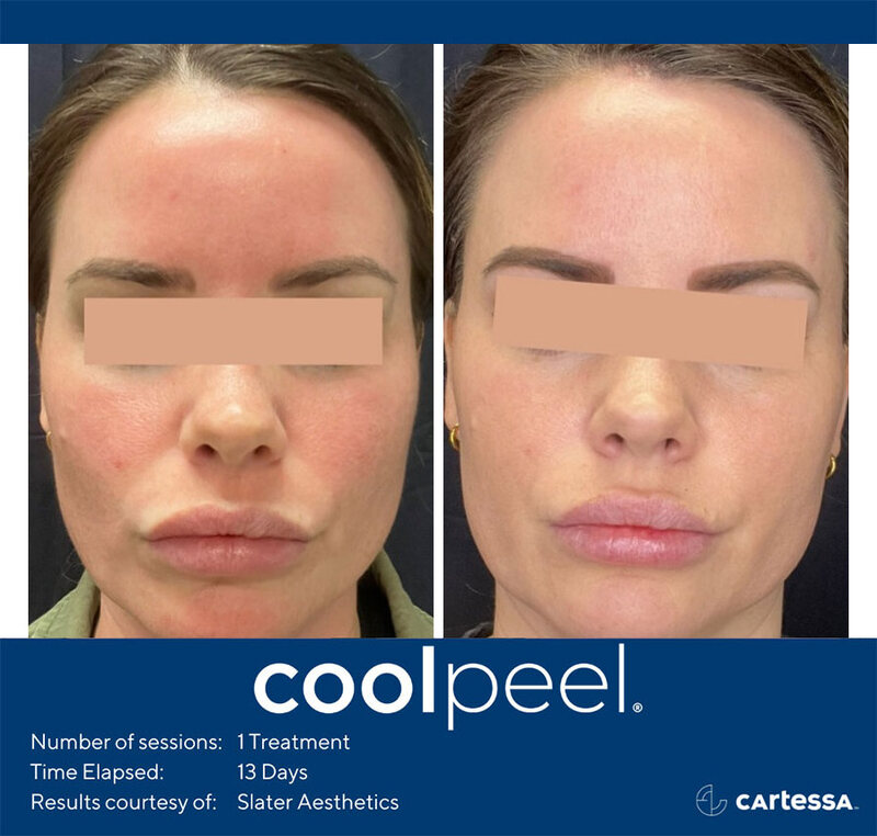 CoolPeel Before & After Image